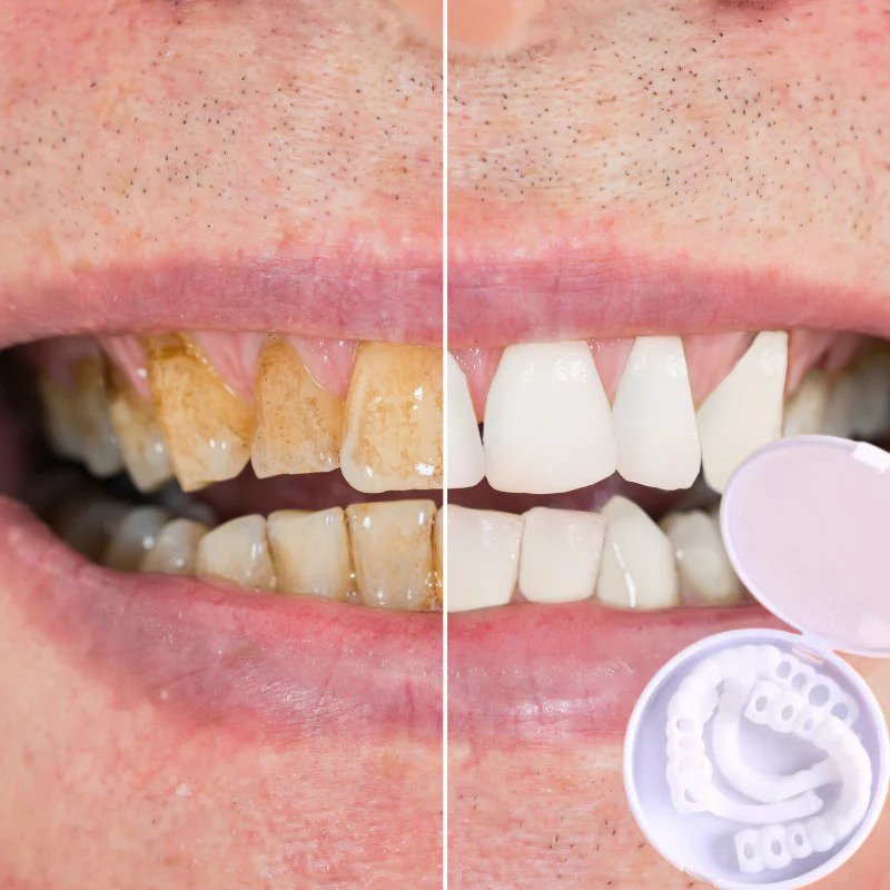 snap-on teeth™ - always the perfect smile with these veneers